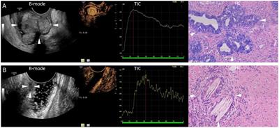 Quantitative analysis of contrast-enhanced ultrasound in neoadjuvant treatment of locally advanced rectal cancer: a retrospective study